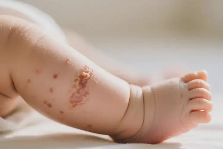 新生兒小腿上容易起濕疹可不可以根治(圖2)