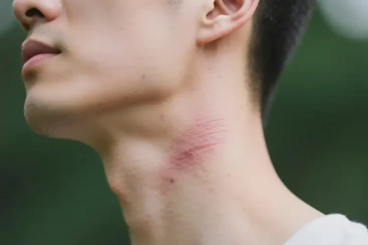 男性脖子有濕疹可以治好嗎(圖1)