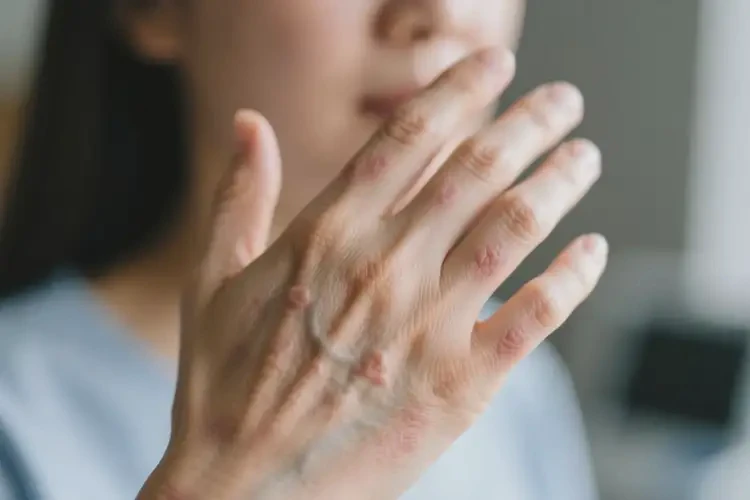 女人手上有濕疹可不可以根治(圖4)