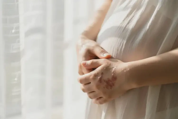 產(chǎn)婦手上偶爾起濕疹可不可以根治(圖1)