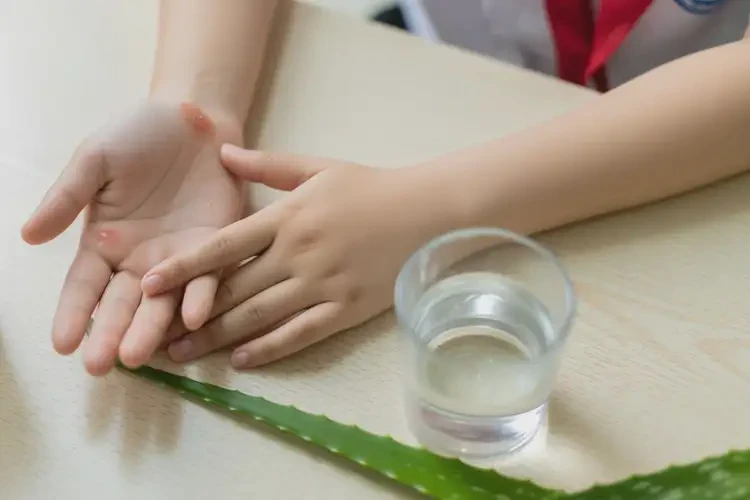 中學生手上起濕疹可不可以根治(圖3)