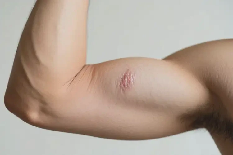 男人手臂經(jīng)常起濕疹可不可以根治(圖4)