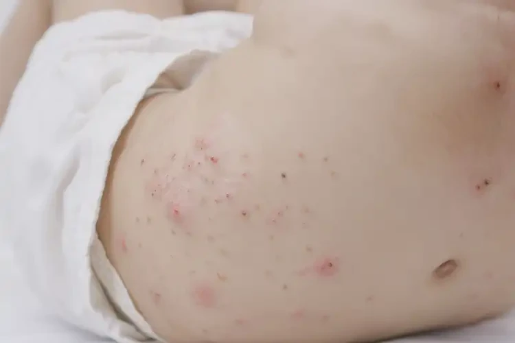 少兒屁股偶爾長(zhǎng)濕疹可不可以根治(圖4)