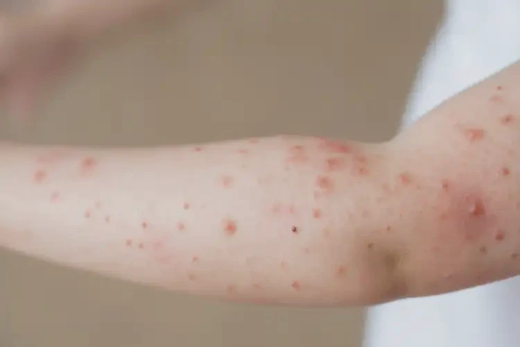 小孩手臂上偶爾長(zhǎng)濕疹可以徹底自愈嗎(圖4)