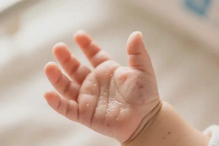 新生兒手上起濕疹可不可以根治(圖4)