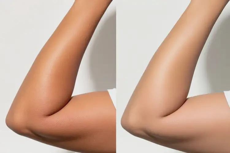 女性手臂上經常長濕疹可以治好嗎(圖4)