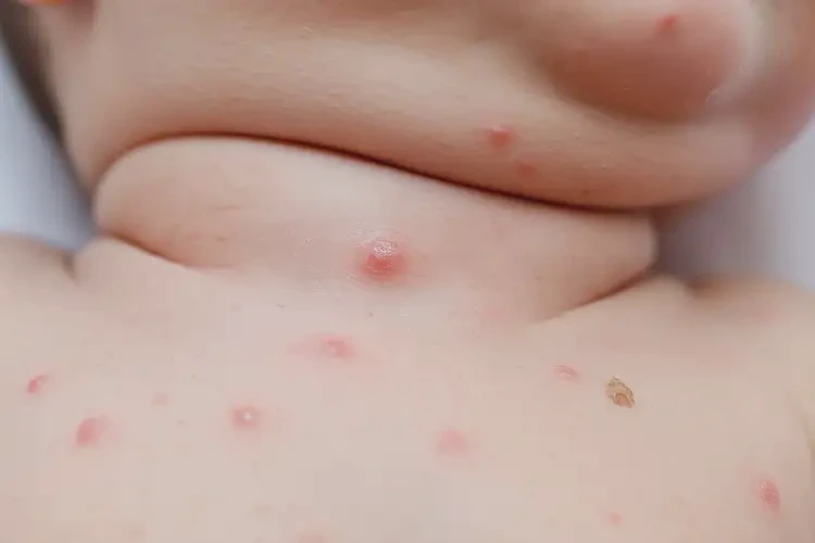 新生兒脖子上偶爾長濕疹可不可以根治(圖4)