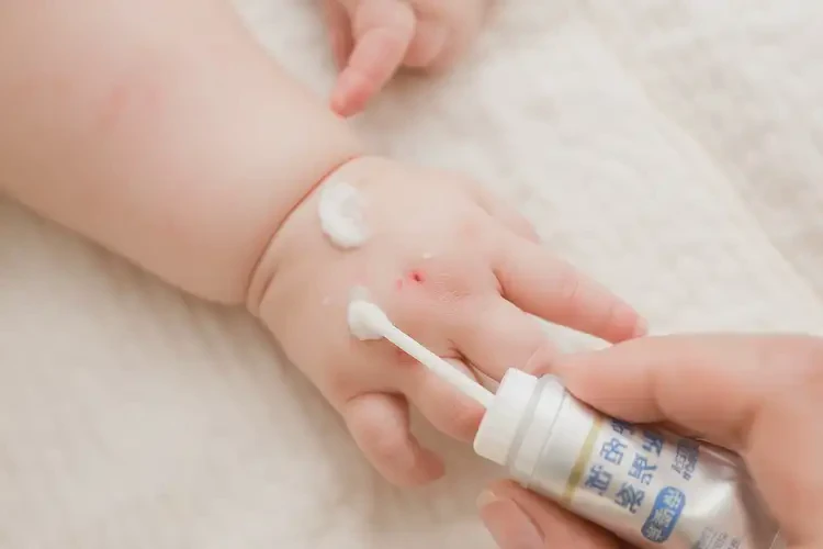 嬰兒手上起濕疹可以治好嗎(圖3)