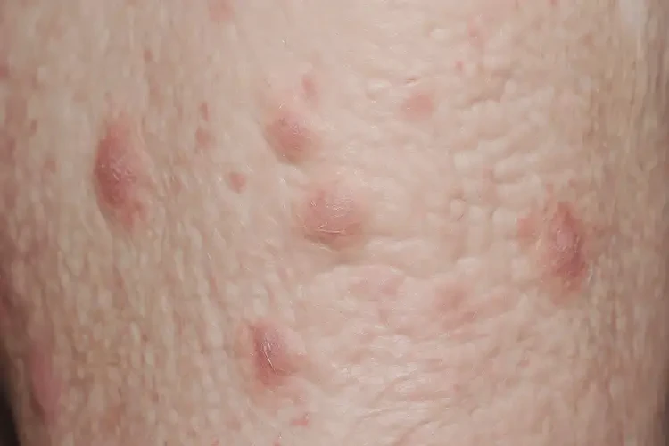 高龄老人大腿偶尔起湿疹可不可以根治(图4)