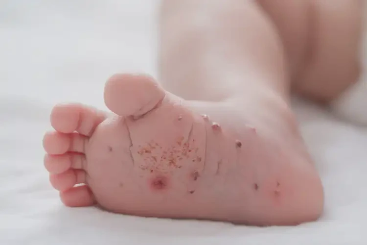新生兒腳上容易起濕疹可不可以根治(圖4)