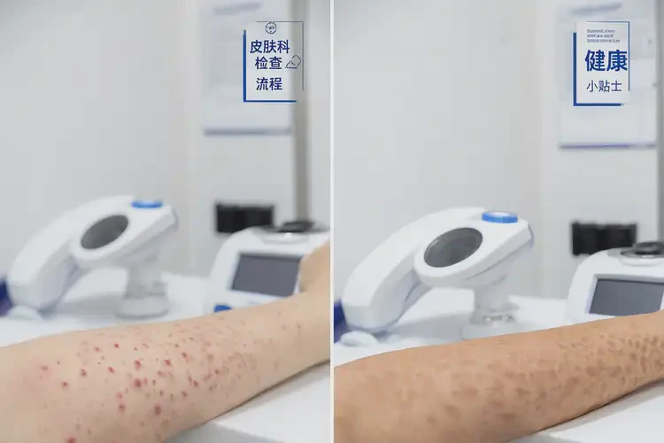 哺乳期媽媽肛周出現(xiàn)濕疹可不可以根治(圖2)