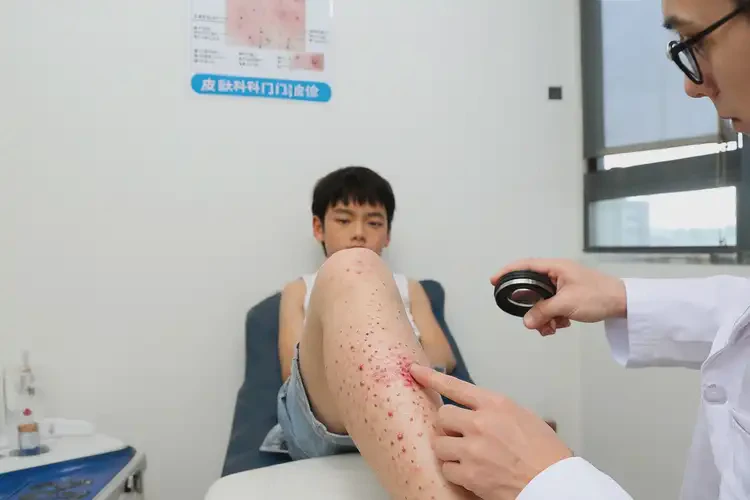 青少年小腿上偶爾長濕疹可不可以根治(圖4)