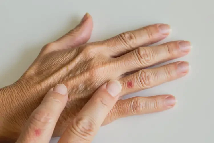 老年人身上起湿疹可不可以根治(图4)