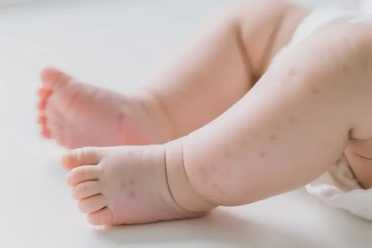 婴儿小腿上出现湿疹可不可以根治(图3)