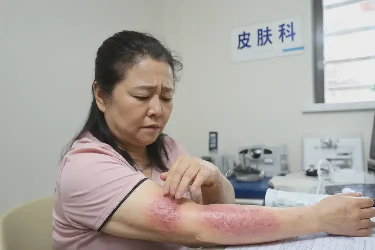 女人手臂上偶爾起濕疹不管它會自己痊愈嗎(圖4)