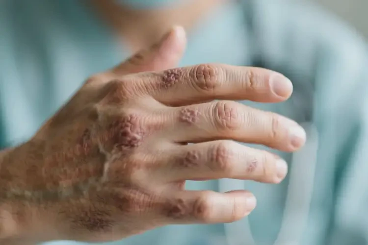 男人手上容易長濕疹可不可以根治(圖1)