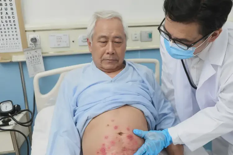 高齡老人肚子上容易起濕疹可不可以根治(圖3)