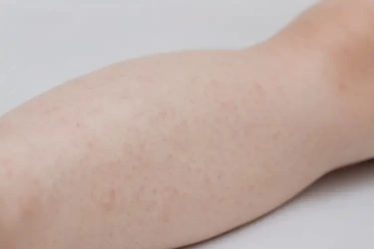 小孩小腿起湿疹可以治好吗(图4)