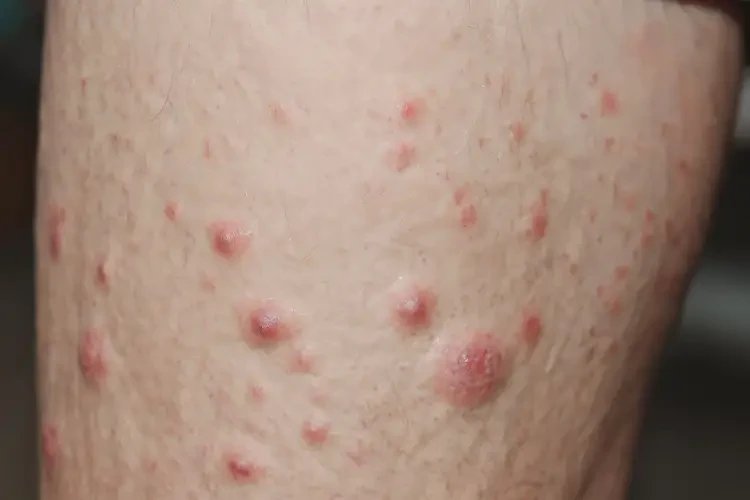 男人大腿偶爾長濕疹可不可以根治(圖4)