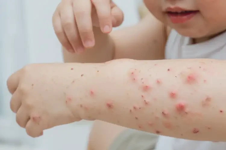小孩手臂偶爾起濕疹可以治好嗎(圖4)