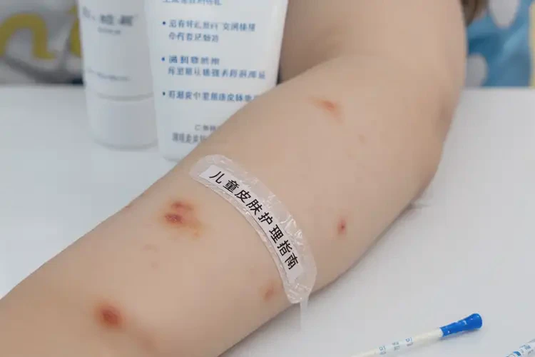 小孩身上出現(xiàn)濕疹可以徹底自愈嗎(圖4)