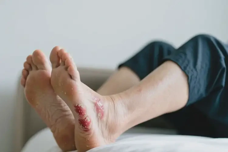 老年人腳上偶爾長濕疹可不可以根治(圖1)