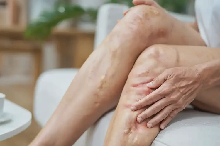 哺乳期媽媽大腿出濕疹可不可以根治(圖4)