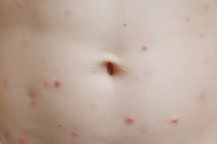 小學(xué)生肚子偶爾長濕疹可不可以根治(圖4)