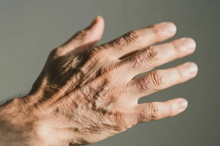男人手上容易長濕疹可不可以根治(圖3)