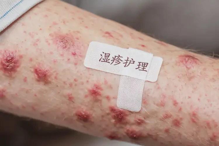老年人四肢偶尔长湿疹可不可以根治(图4)