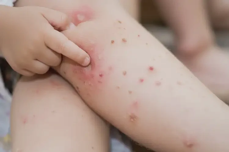 小孩小腿容易起湿疹可以治好吗(图4)