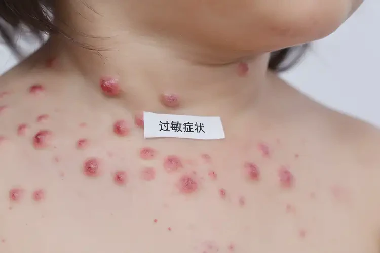 小兒脖子起濕疹可以治好嗎(圖4)