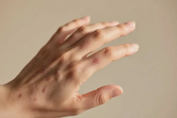 女人手上有濕疹可不可以根治(圖2)