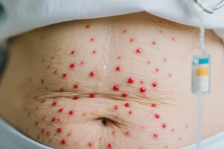 老年人肚子偶尔长湿疹可不可以根治(图3)