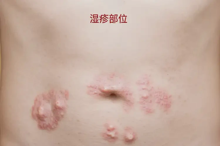 中學(xué)生肚子長(zhǎng)濕疹不管它會(huì)自己自愈嗎(圖4)
