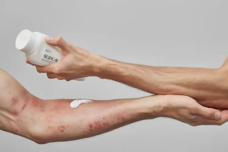 青年人手臂上有濕疹可不可以根治(圖3)