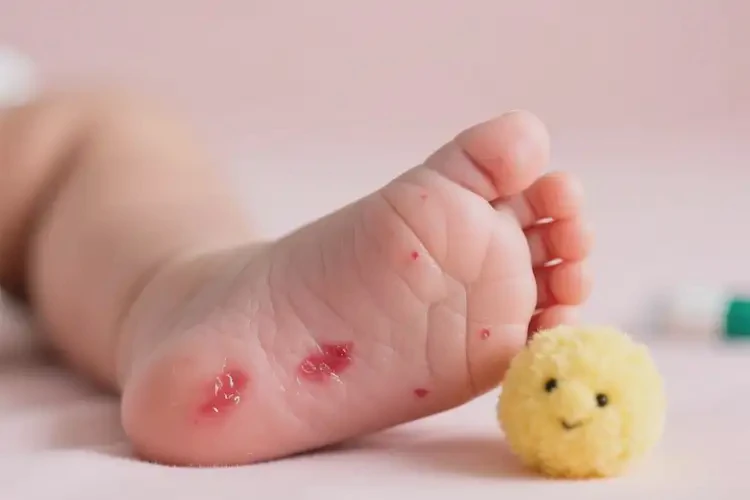 新生兒腳上容易長(zhǎng)濕疹可不可以根治(圖2)