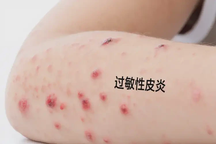 小孩身上偶尔起湿疹可以治好吗(图4)