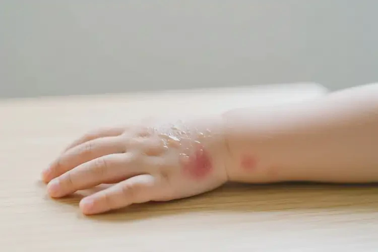 小兒手上容易起濕疹可以治好嗎(圖3)