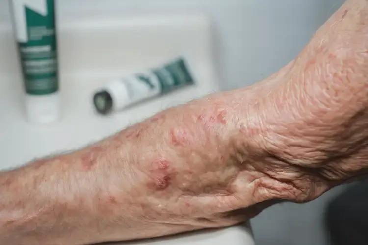 老人四肢出濕疹可不可以根治(圖4)