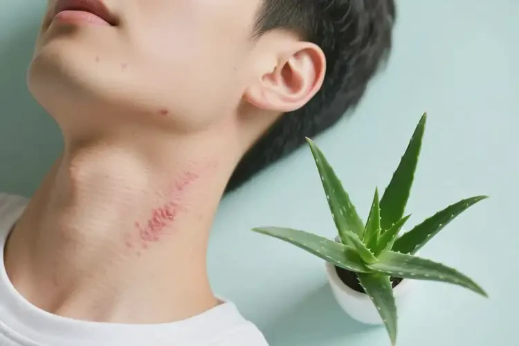 青年人脖子容易起濕疹可不可以根治(圖2)