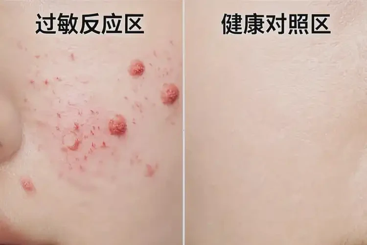 男人身上偶爾長濕疹可不可以根治(圖3)