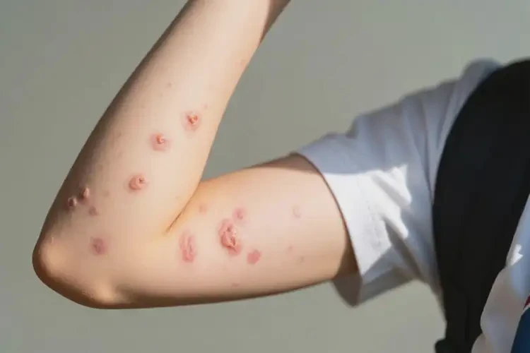 中學(xué)生手臂上偶爾起濕疹可不可以根治(圖3)