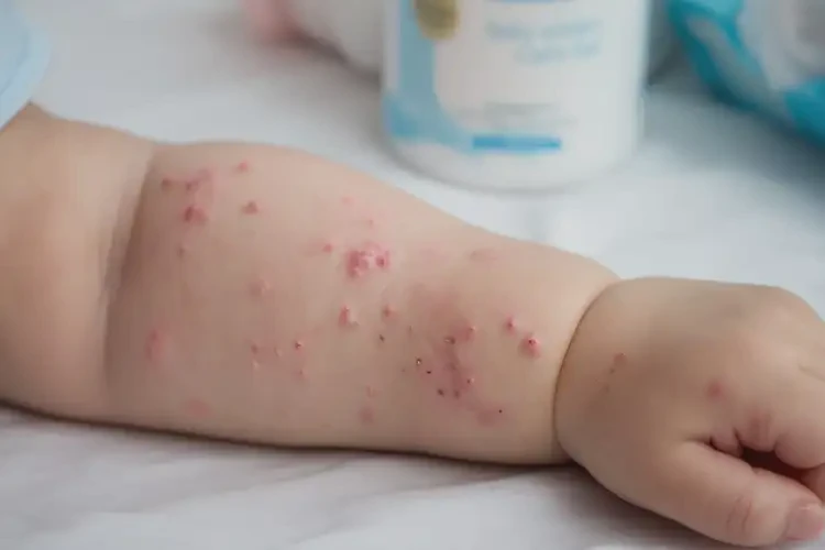 寶寶手臂上起濕疹可以治好嗎(圖4)
