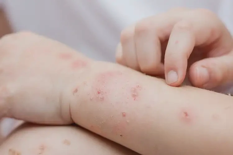 兒童手臂起濕疹可以治好嗎(圖4)