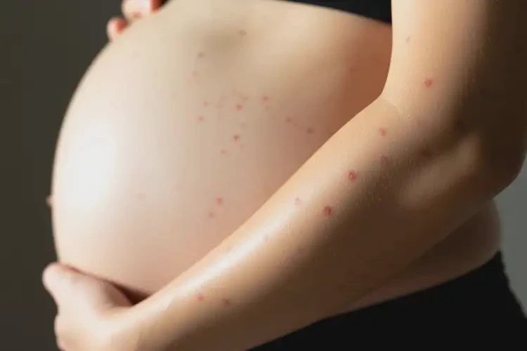 孕婦手臂上偶爾起濕疹可不可以根治(圖1)