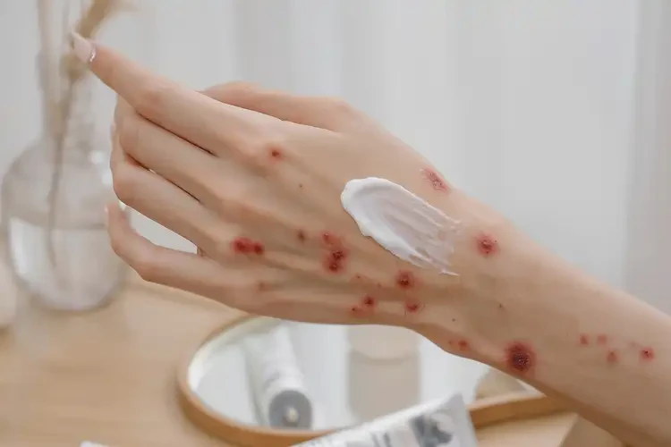 女人手上偶爾起濕疹可不可以根治(圖4)