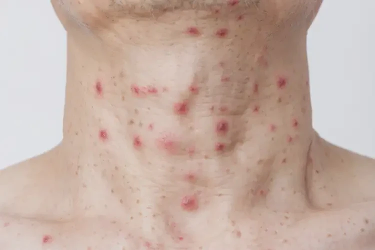 男人脖子上出湿疹可不可以根治(图3)