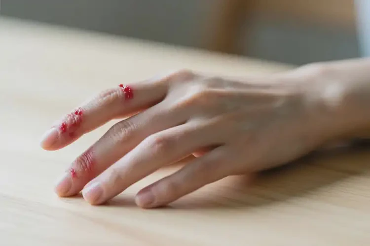 女性身上偶爾長濕疹可不可以根治(圖4)