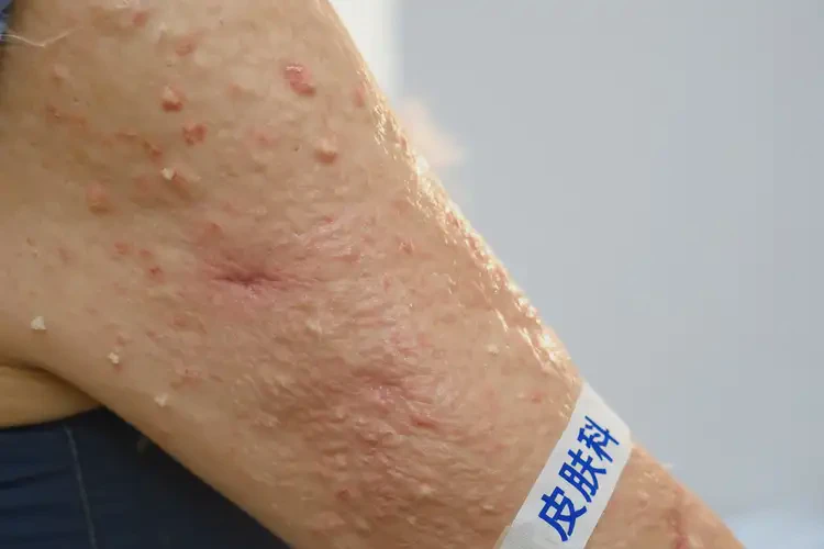 女性手臂偶尔起湿疹可不可以根治(图4)